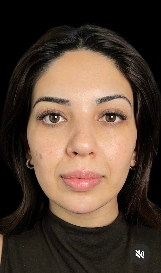 Microneeling After