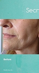 Botox After